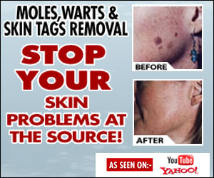 mole removal at home